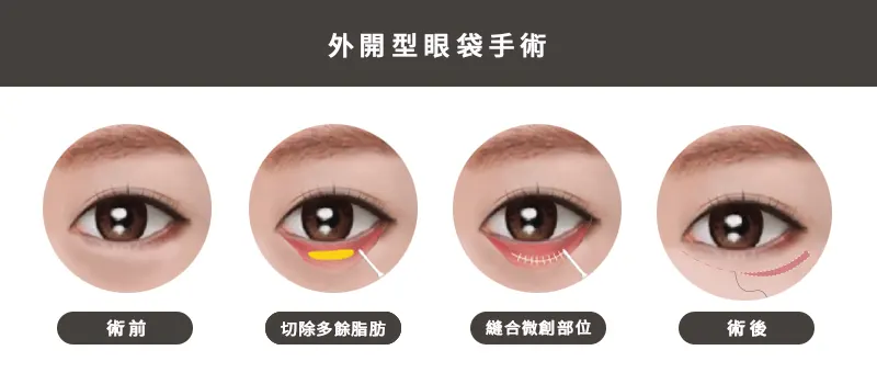 外開型眼袋手術