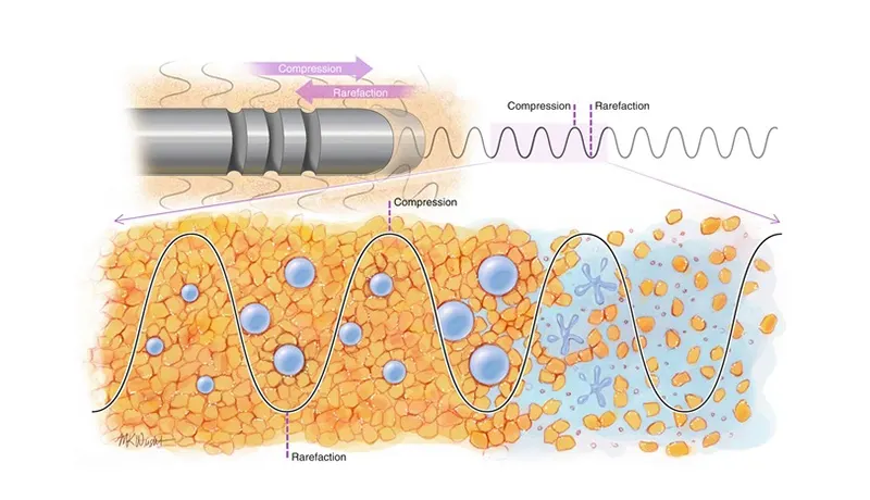 Fat transfer breast augmentation can add only 1 cup size