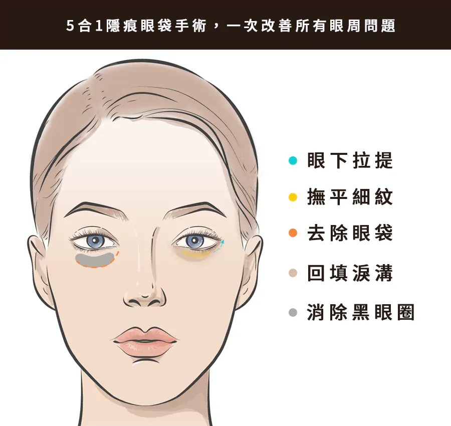 5合1隱痕眼袋手術