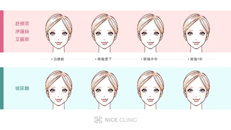 舒顏萃、洢蓮絲、艾麗斯和玻尿酸差在哪