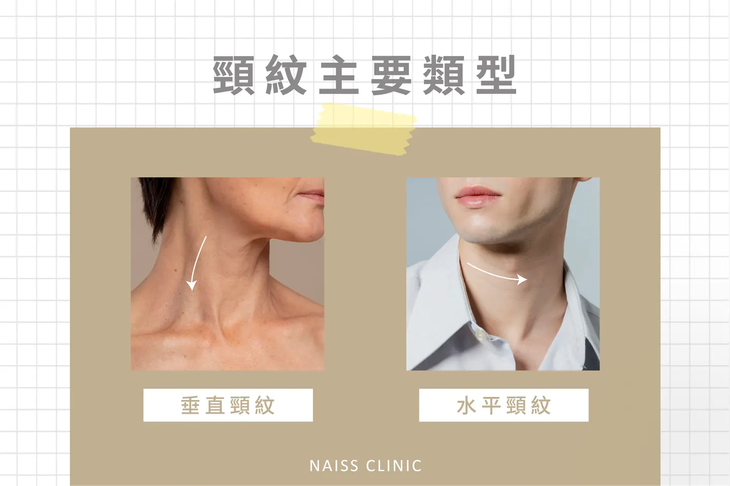 頸紋有哪些類型？動態紋與靜態紋怎麼分？ 