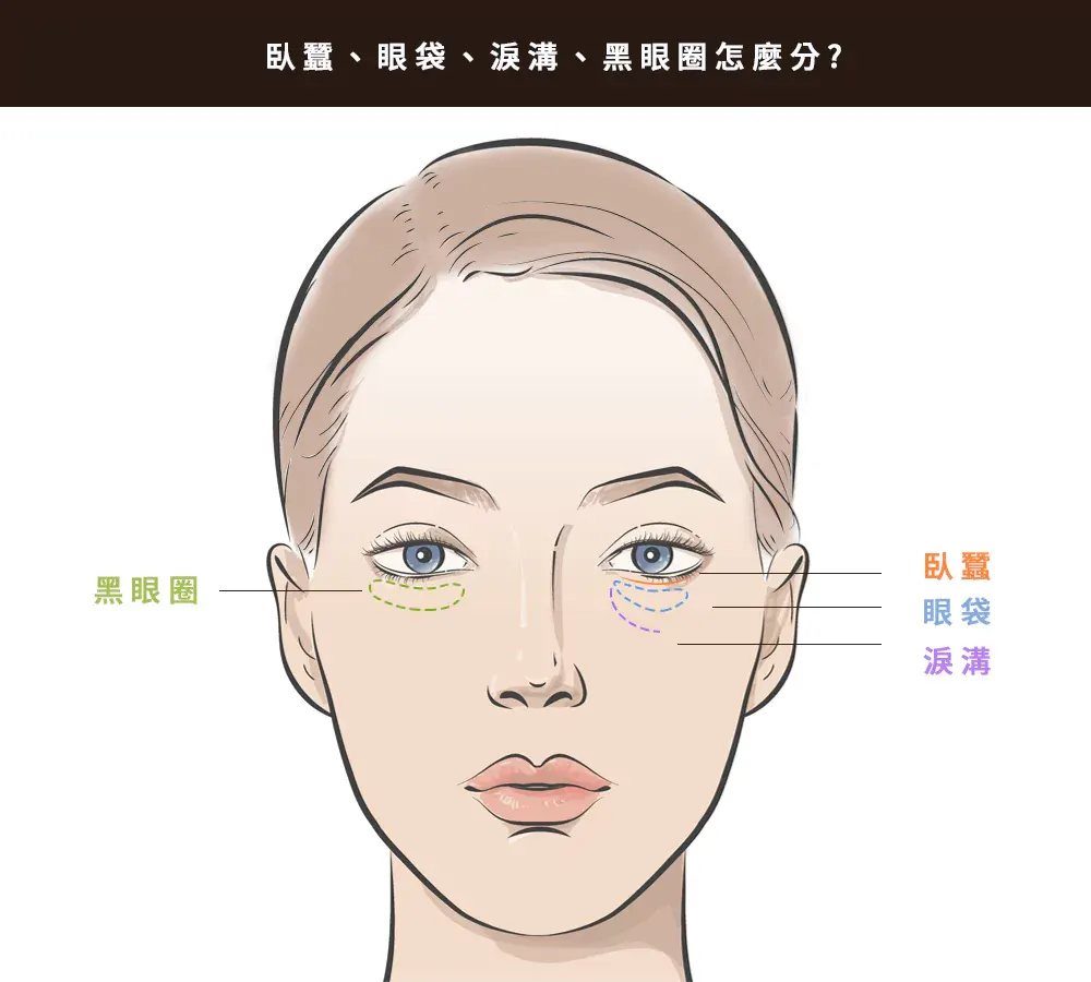 眼袋、黑眼圈、淚溝、臥蠶怎麼分？