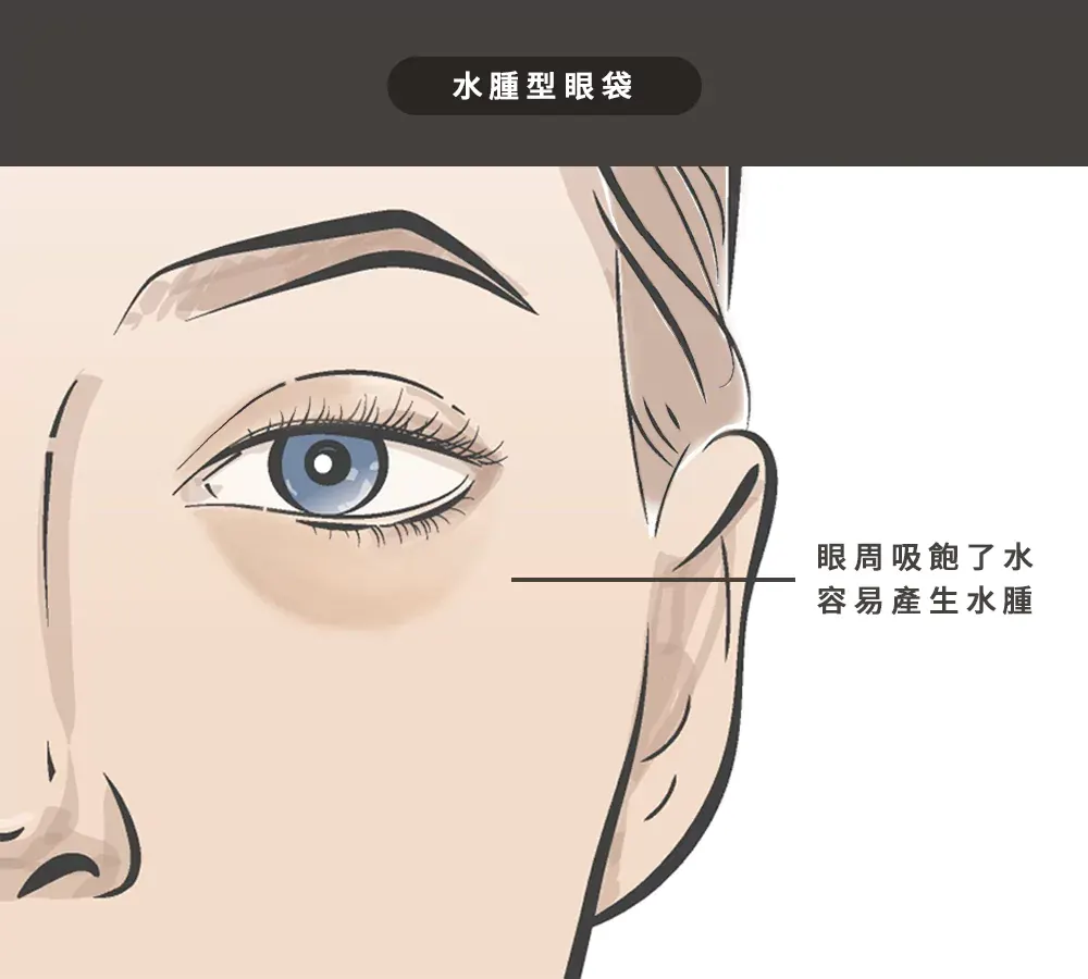 1、水腫型眼袋