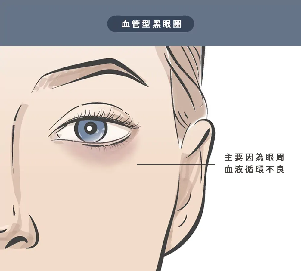 3、血管型黑眼圈