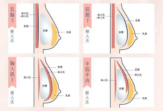 1103隆乳植入位置文章用圖_201104_0_0