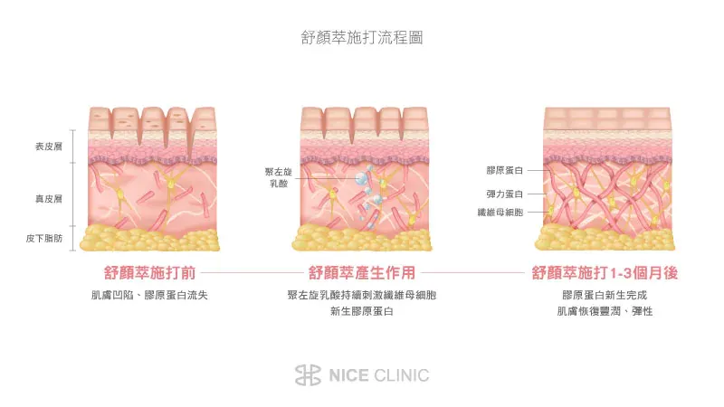  注射舒顏萃