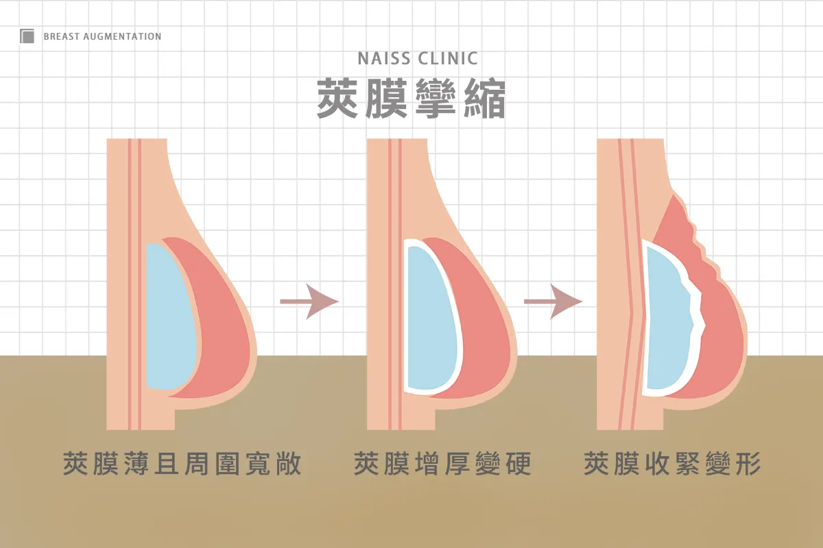 莢膜攣縮