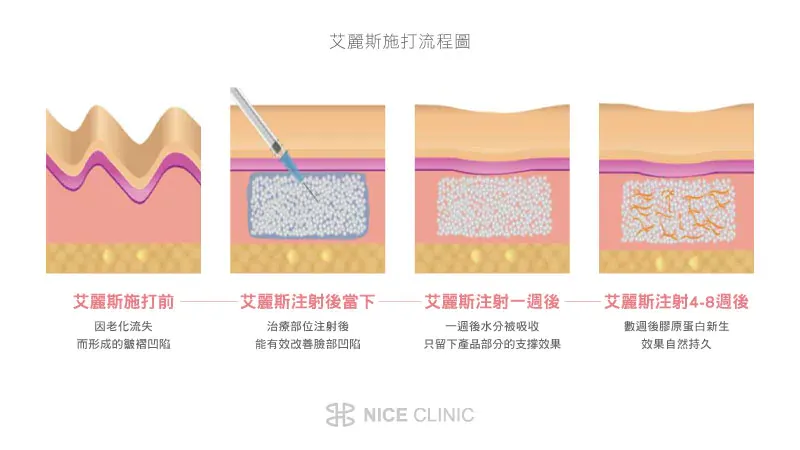  艾麗斯施打