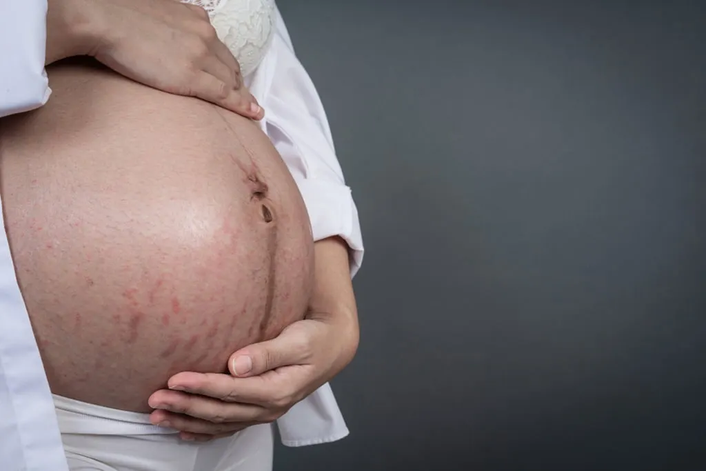 When do stretch marks appear?