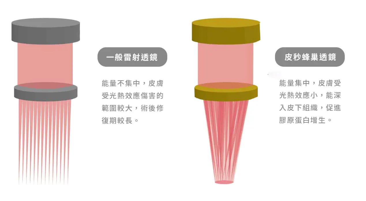 施打皮秒雷射時，加入蜂巢透鏡可以產生聚焦效果，把原本的能量聚焦放大25倍