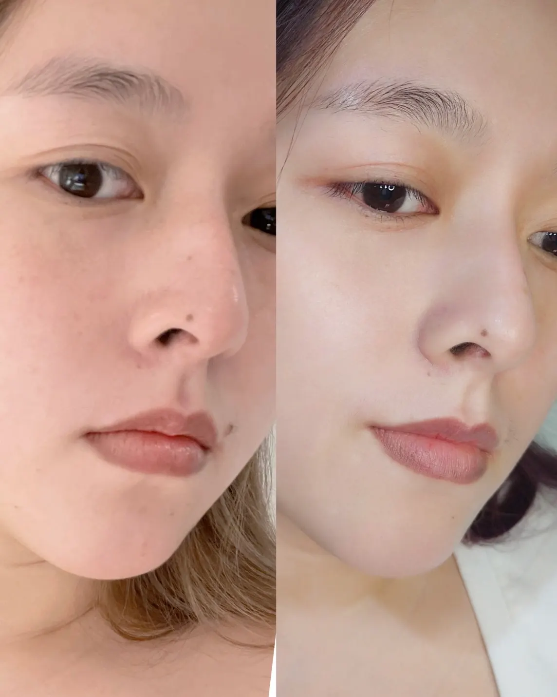Vital Injector skin booster before and after