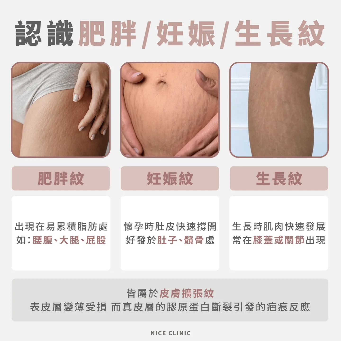 
What are stretch marks and how do they form?

