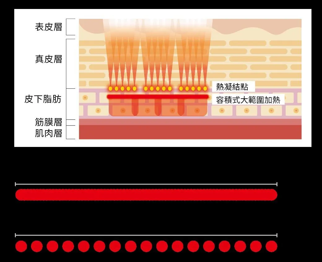 「音波拉提」是一種非侵入性、幾乎無需恢復期的治療，透過探頭將超音波能量聚焦，直接刺激肌膚底下的筋膜層（SMAS)，熱能刺激產生收縮反應，立即達到拉提效果，也能促進膠原蛋白增生，進而淡化細紋、使肌膚恢復彈性。