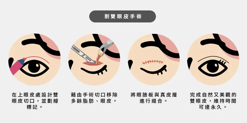 割雙眼皮手術