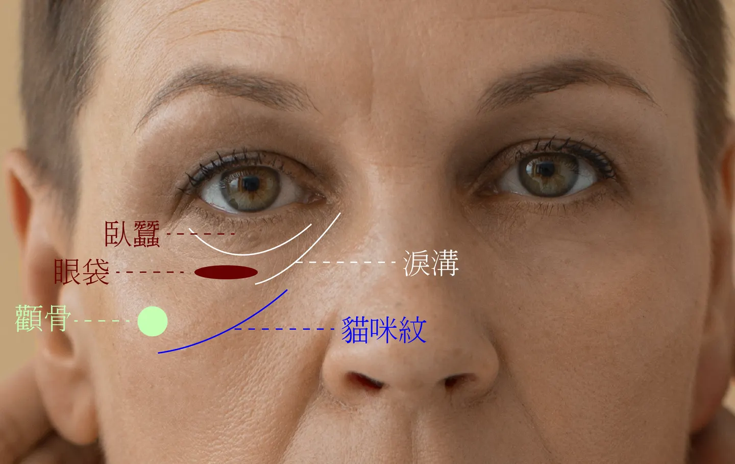 貓咪紋/印地安紋不是淚溝！？3大成因一次看！