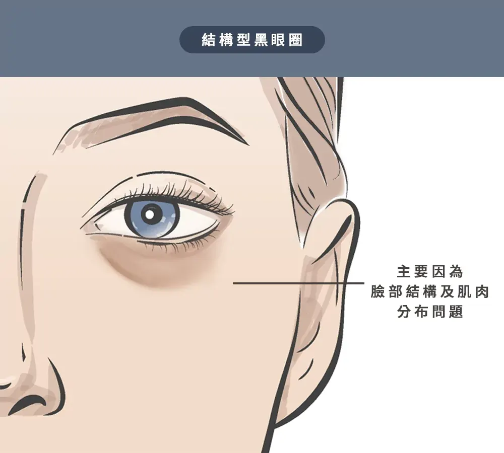3、結構型黑眼圈