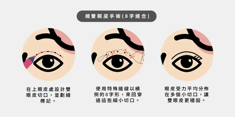 8字縫雙眼皮