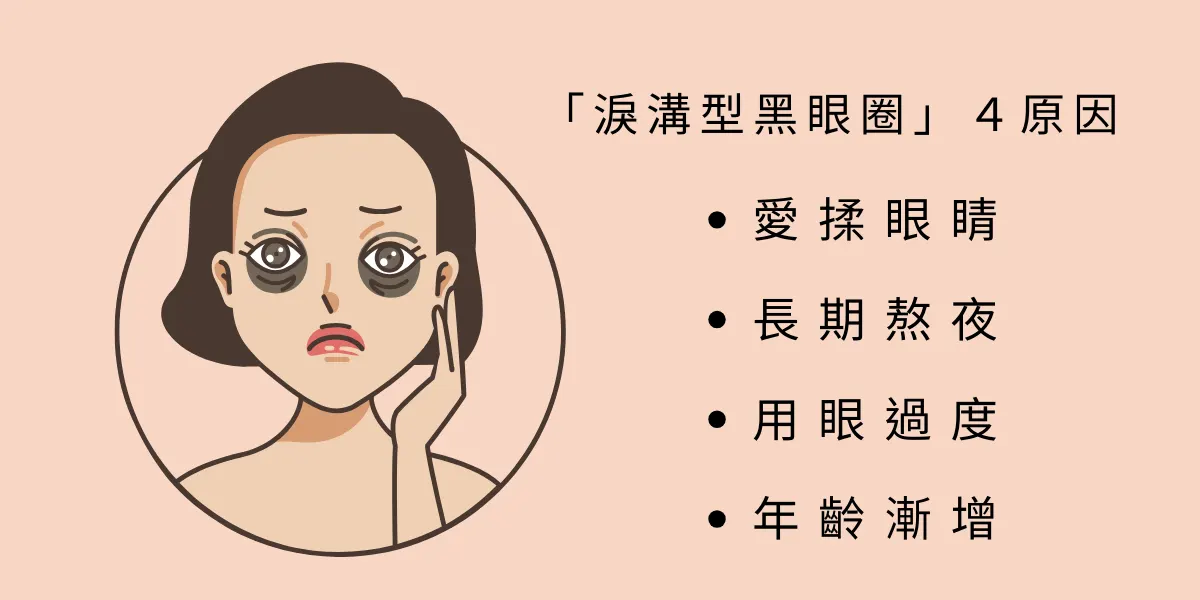 Dark circles can be divided into three main types:
1. Tear trough dark circles: shadows caused by hollowing from tear trough depressions, bulging eye bags, or a descending cheek apple.
2. Vascular dark circles: blood vessels sit close to the surface and outline the dark circle.
3. Pigmented dark circles: caused by factors such as skin pigment deposits, thickened keratin, a thickened spinous layer, or laxity.
Patients usually have either a combined type or a single type, but the most common is tear trough dark circles, arguably the trickiest type! It is usually caused by everyday bad habits: rubbing the eyes often, staying up late for long periods, and overusing the eyes on phones as many people do today, combined with aging as the years go by.