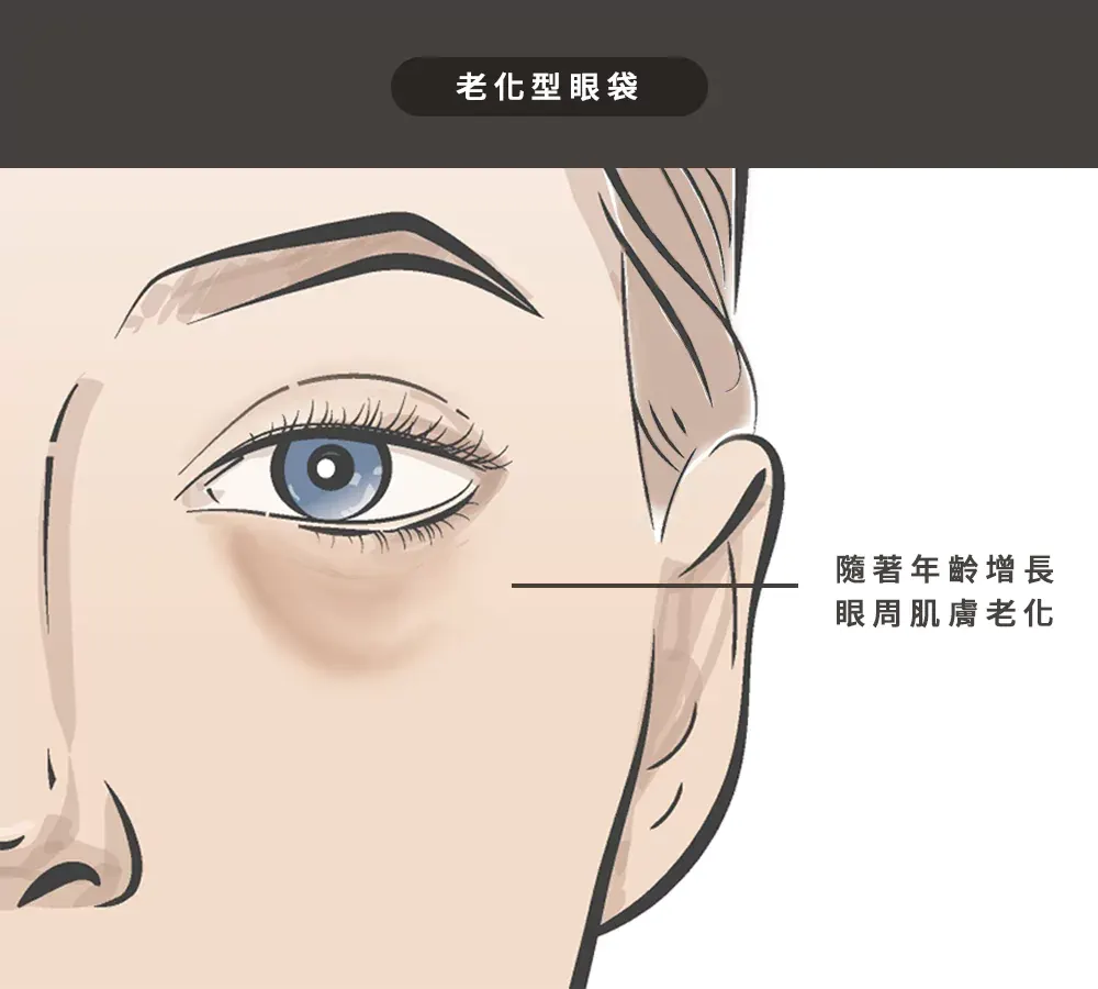3、老化型眼袋