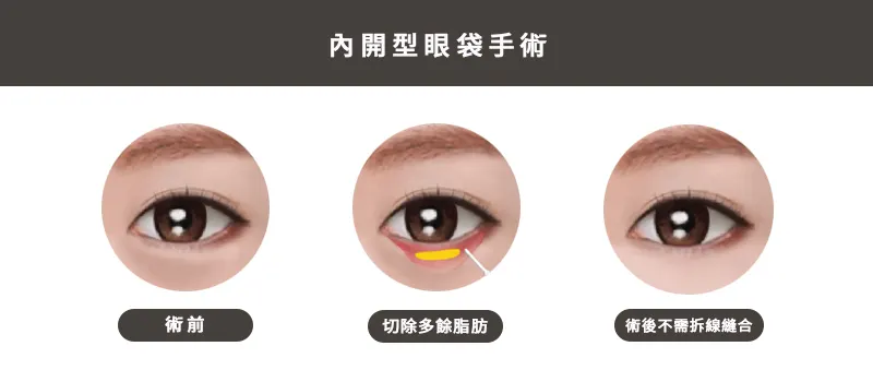 內開型眼袋手術