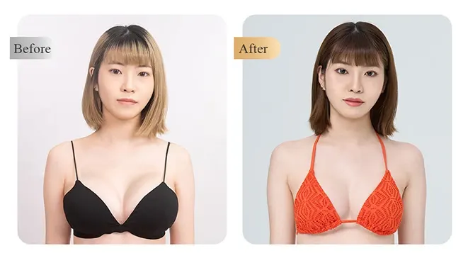 Perle breast augmentation case study