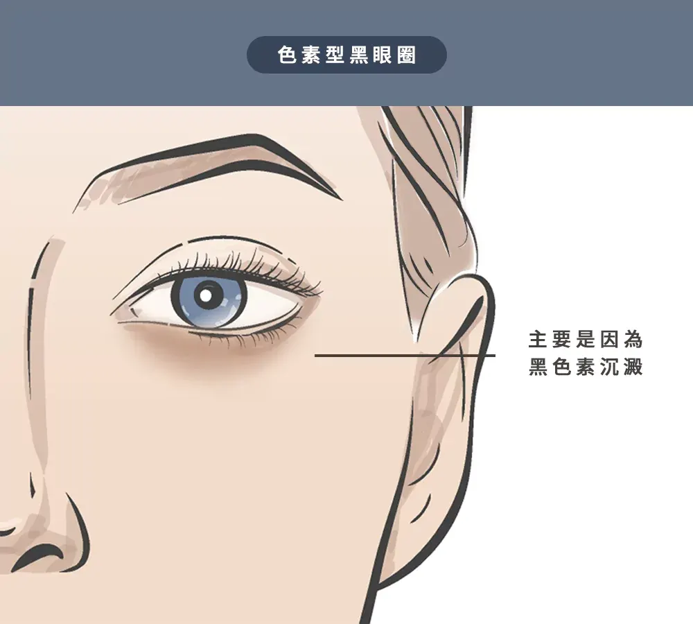 1、色素型黑眼圈