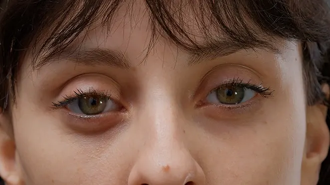 4 Types of Puffy, Tired-Looking Eyes and How to Fix Them