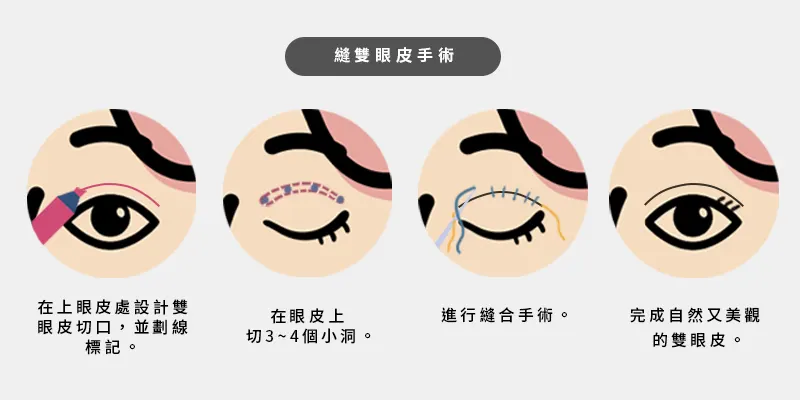縫雙眼皮手術