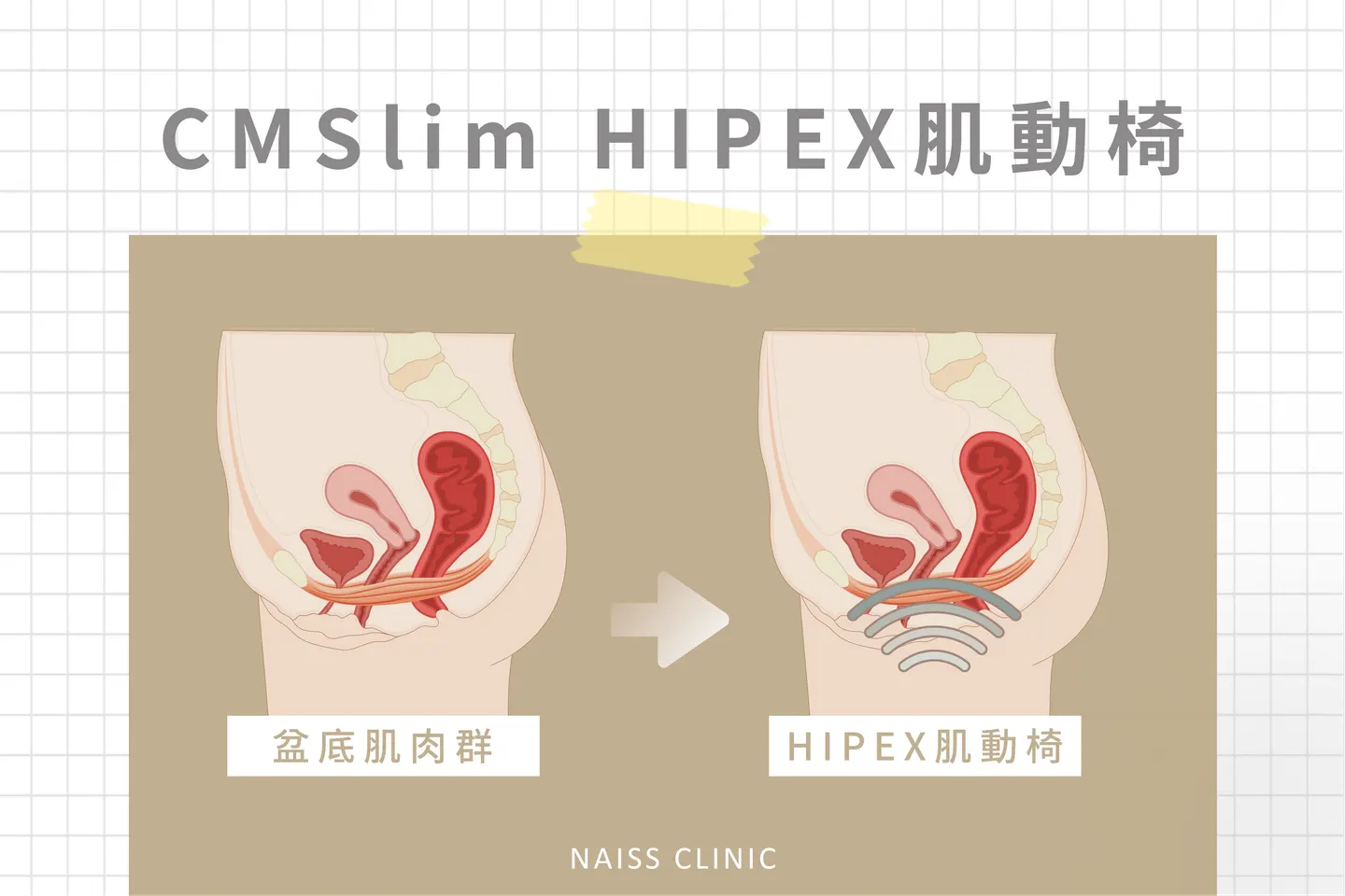CMSlim先舒立也可以治療漏尿？ 