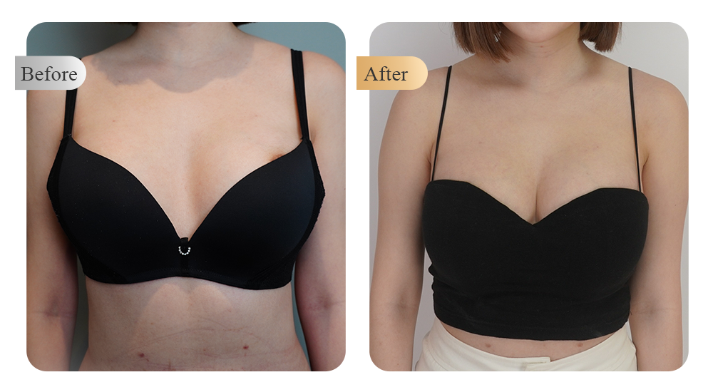自體脂肪隆乳案例分享