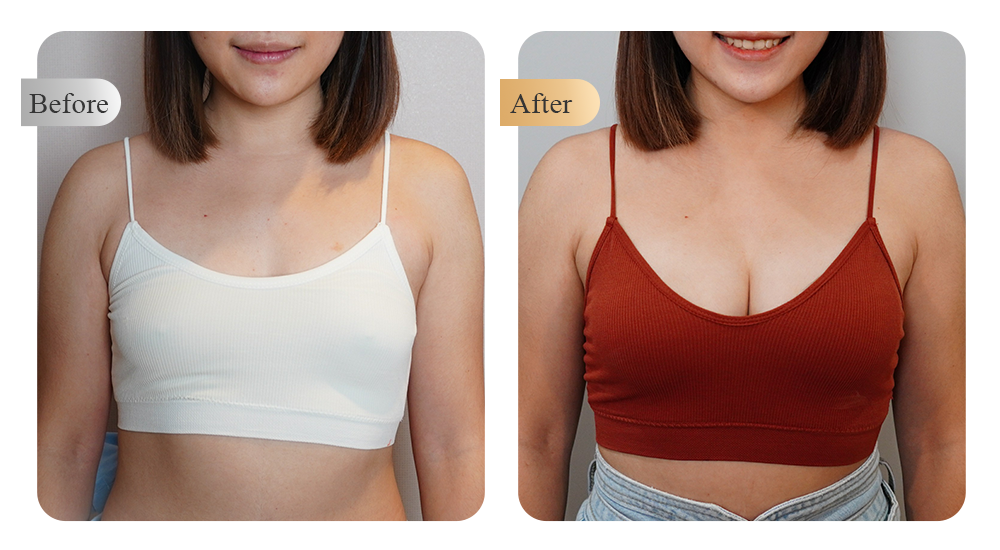 自體脂肪隆乳案例分享