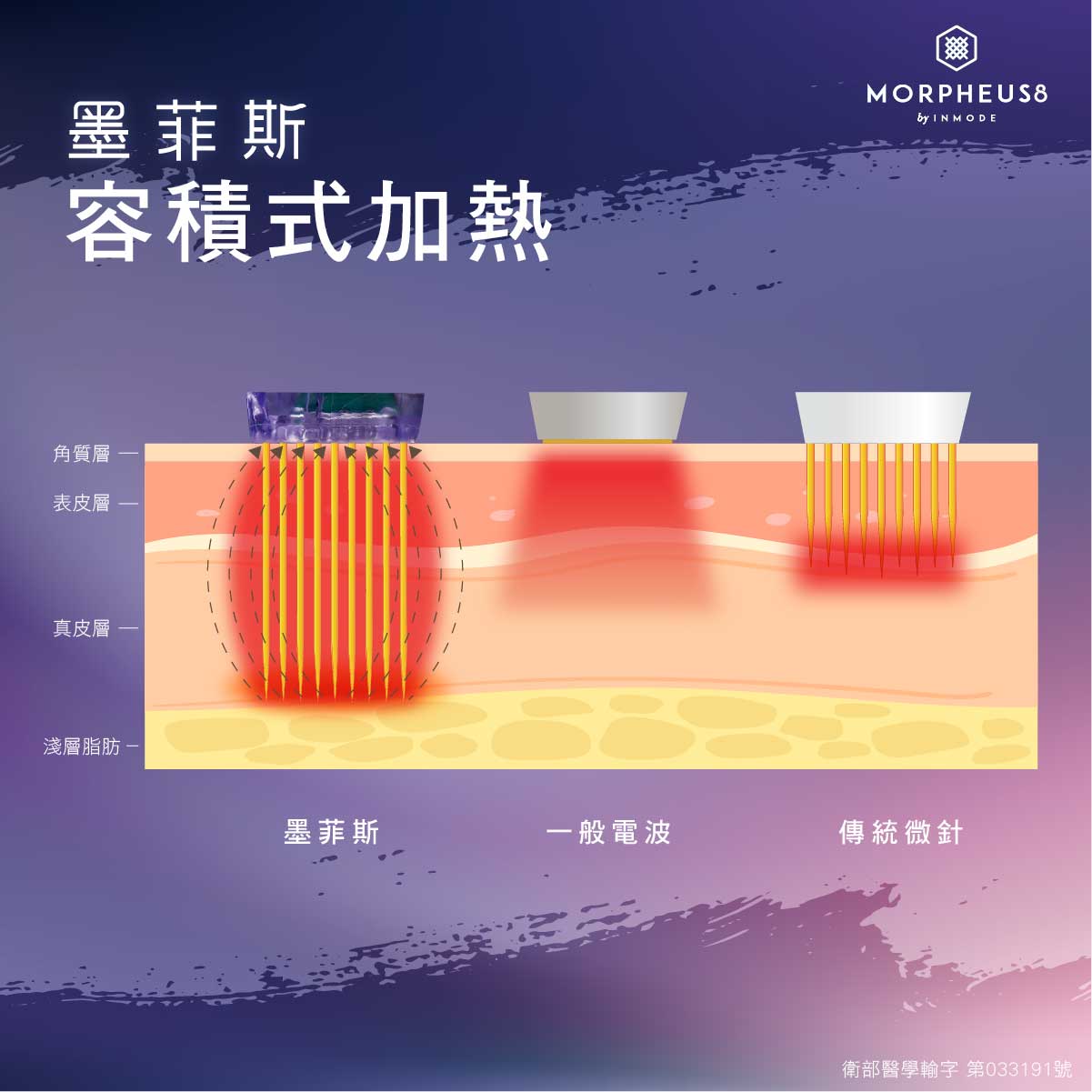 墨菲斯電波(海神電波)結合了微針以及電波,利用微針破壞表皮和真皮組織,刺激皮膚再生反應,並藉由電波加熱深層組織,誘導新生膠原蛋白產生。
