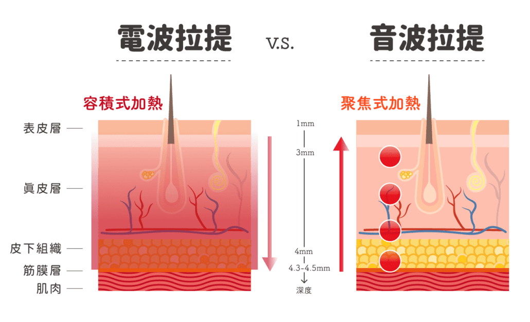 所謂電波拉皮是利用高頻率的電子流動,在肌膚與脂肪組織間產生立體式加熱效果,進而刺激膠原蛋白的增生重組和組織收縮,達到緊緻肌膚、撫平褶皺的效果。