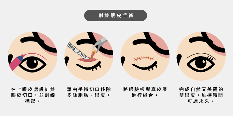 割雙眼皮手術