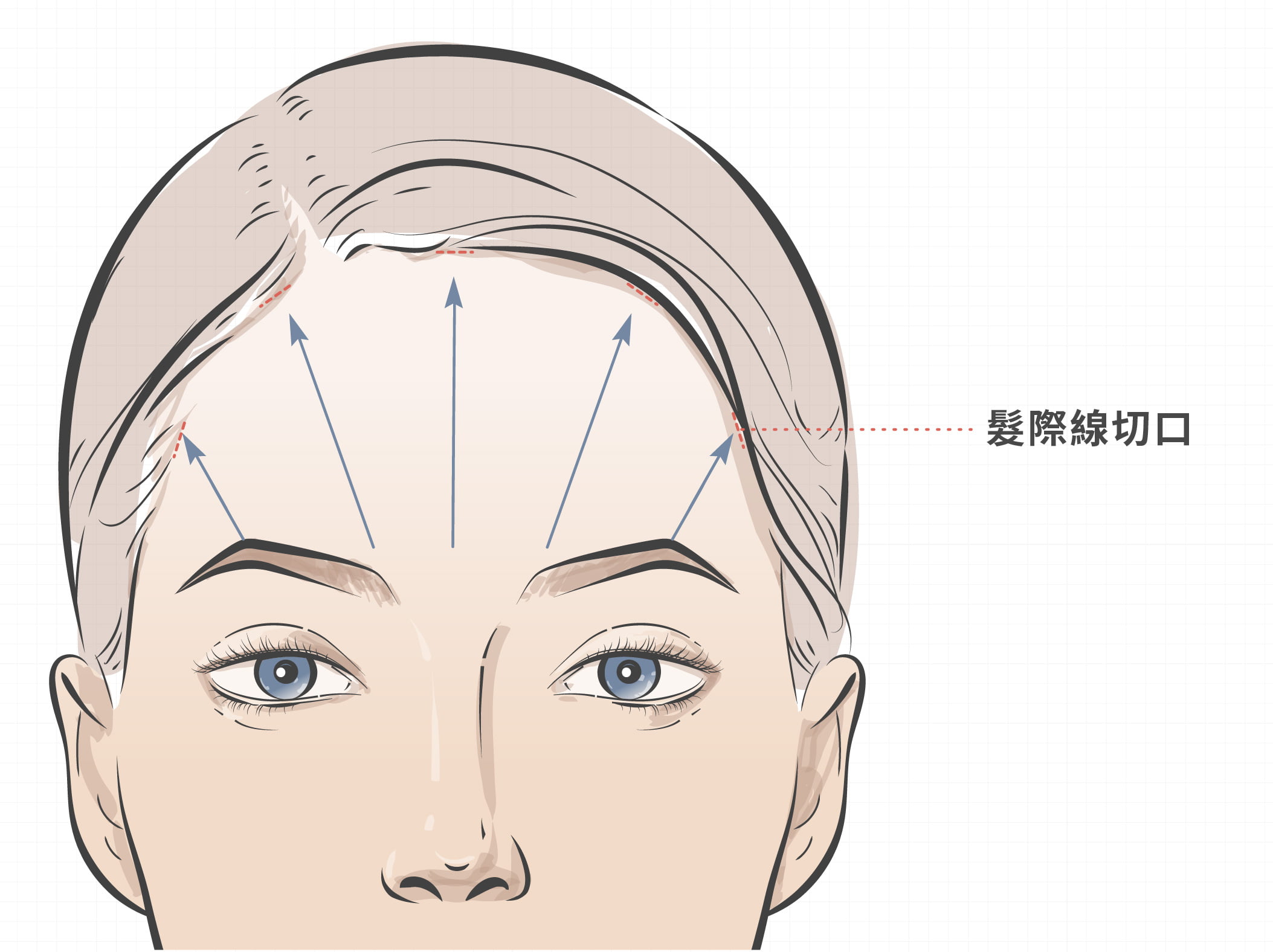 前額拉皮手術
