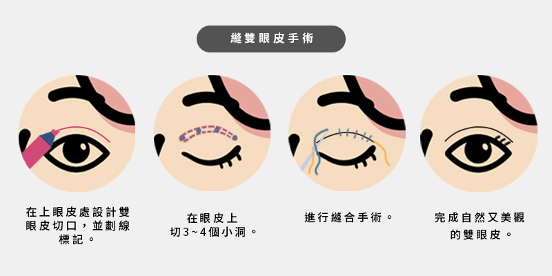 縫雙眼皮手術