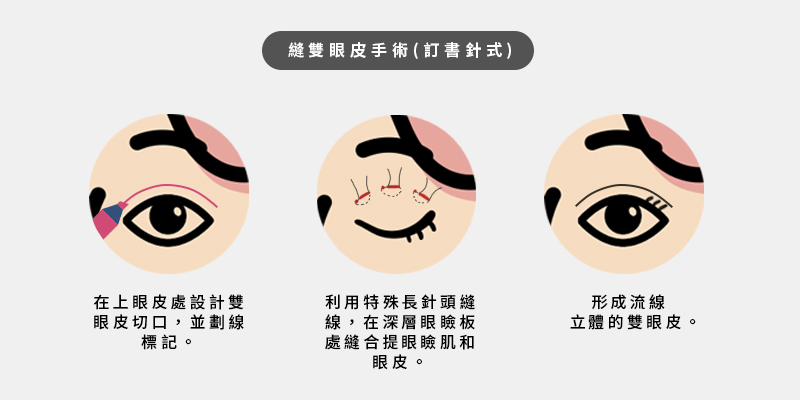 割雙眼皮手術(釘書針式)
