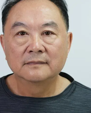 療程前