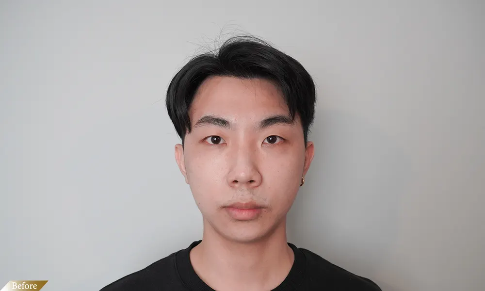 療程前