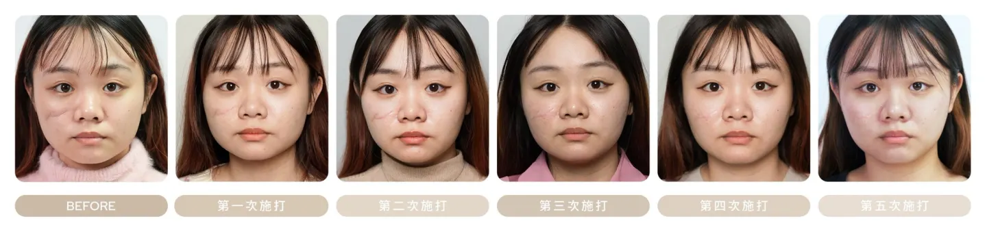 PLT 生長因子治療凹陷疤痕，正面治療前與第一至第五次施打後對比