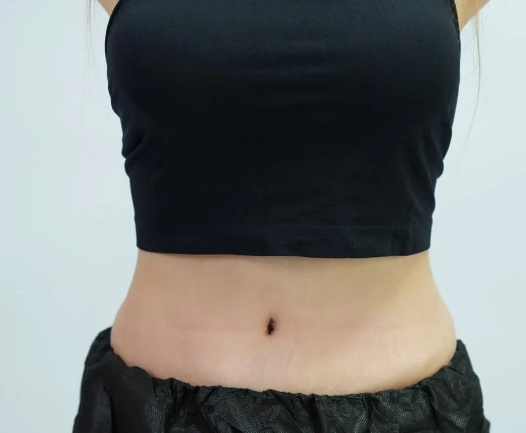 After, front view: flat abdomen and defined waist