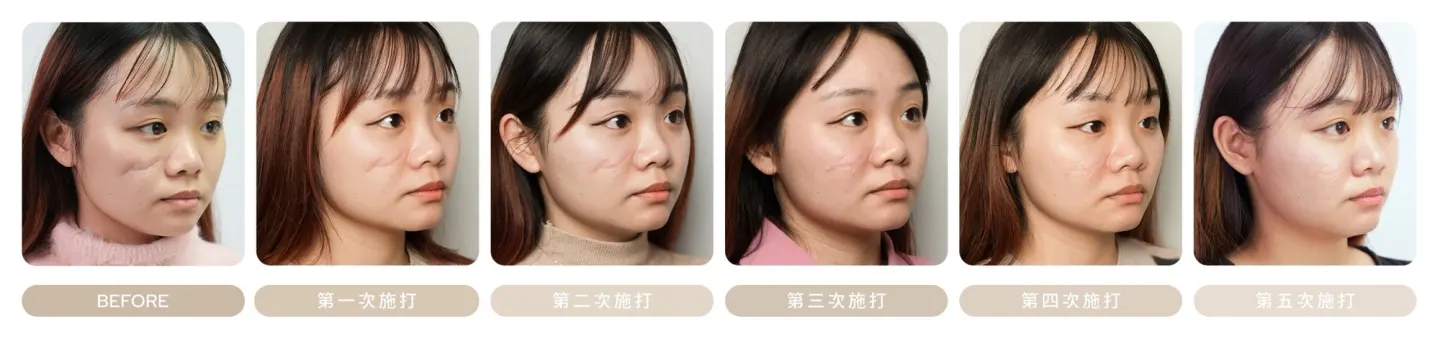 PLT 生長因子治療凹陷疤痕，45 度角治療前與第一至第五次施打後對比