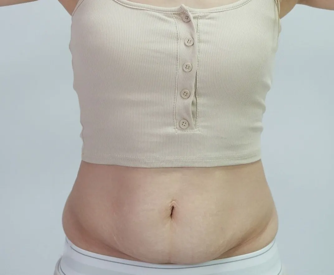 Before, front view: loose lower abdomen after childbirth and an undefined waist