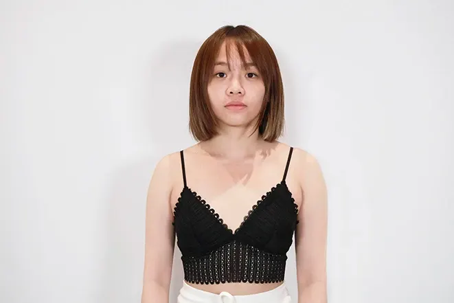 療程前
