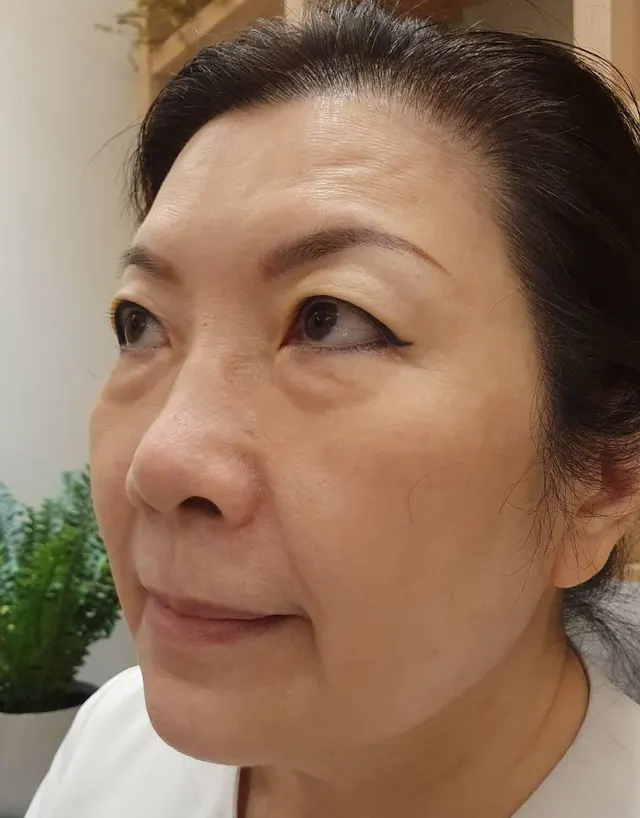 【眼袋手術案例】眼袋隱形術！視覺年齡再年輕10歲的祕密大公開